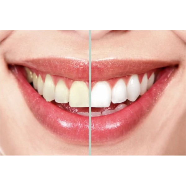 Kit de blanchiment des dents Premium