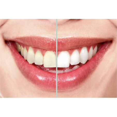 Kit de blanchiment des dents Premium