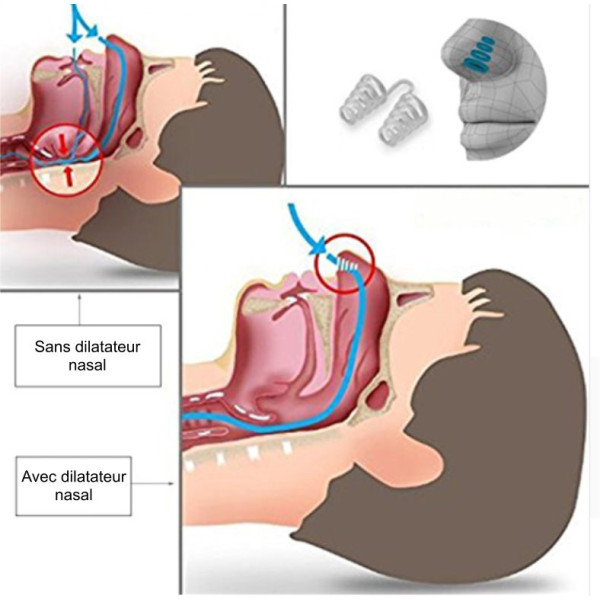Anti-ronflement strap manibulaire + gouttière + écarteur nasal