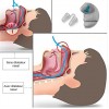 Anti-ronflement strap manibulaire + gouttière + écarteur nasal