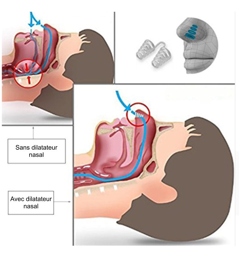 Solution Anti-Ronflement : Sangle + gouttière + écarteur nasal