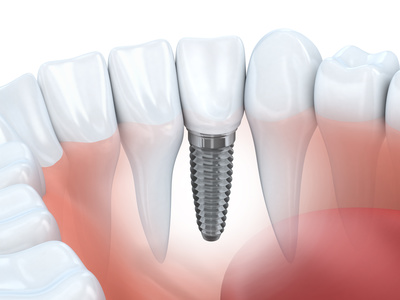 l’implant dentaire, alternative onéreuse à la colle pour dentiers