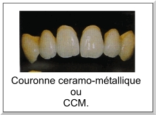 Les Céramo-métalliques