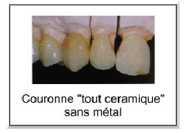 couronne céramique sans métal