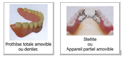 La prothèse dentaire. Qu'est ce que c'est? Types de prothèses dentaires