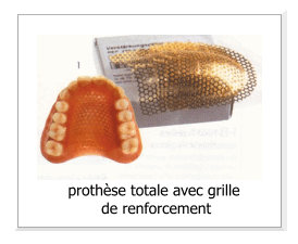 dentier grillage palais renforcé