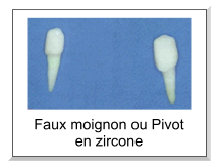 faux moignon en zircone