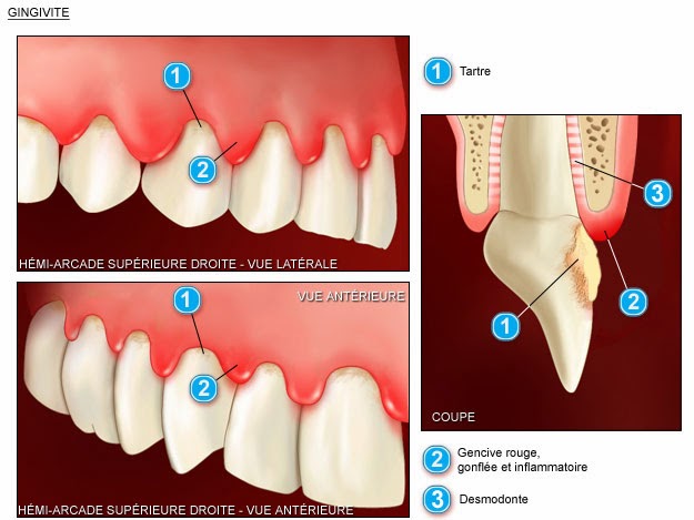 Bicarbonate et eau oxygénée recommandation dentistes pour les gencives