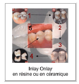 inlay onlay en résine