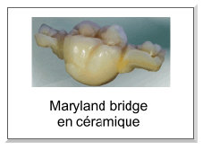 Maryland bridge en céramique