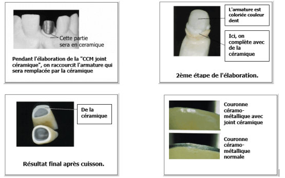 joint dent céramique prothèse