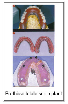 prothèse sur implant