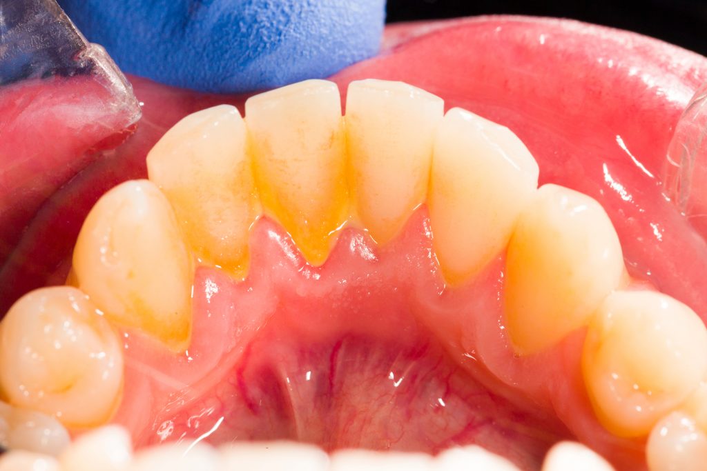 Tartre Dentaire Et Détartrage Des Dents