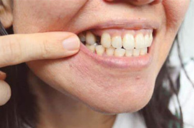 Une dent manquante : Causes, conséquences et solutions