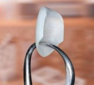 Les facettes dentaires